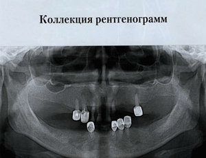 Скачать Коллекция рентгенограмм (Ортопантомограммы)